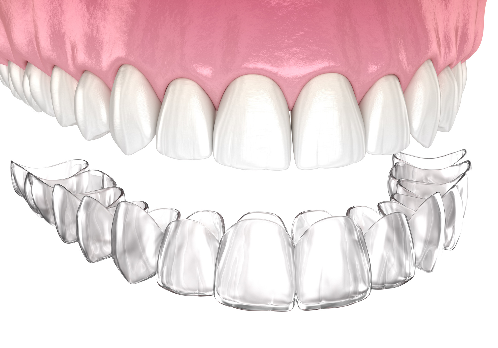 Clear Aligners