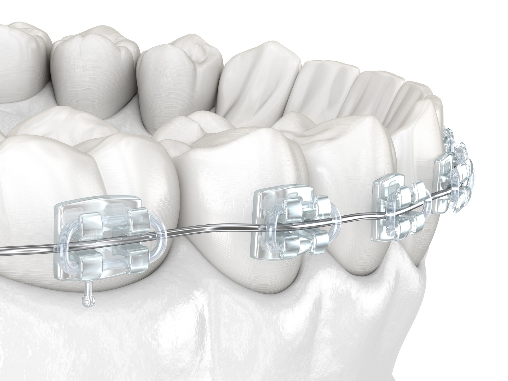 Clear Ceramic Braces