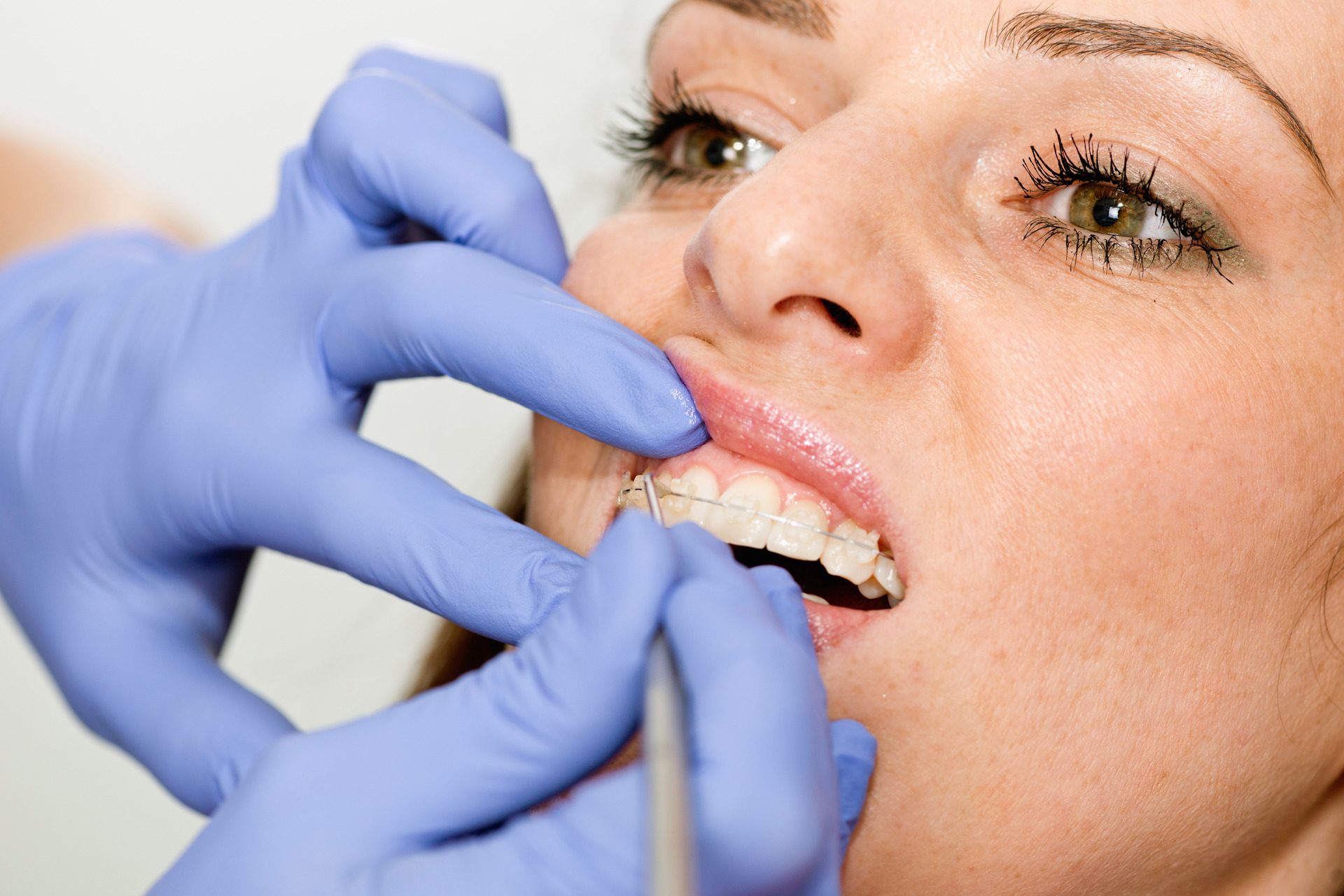 Close-up of ceramic braces