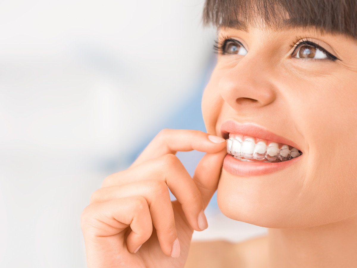 Close-up of Spark Aligners