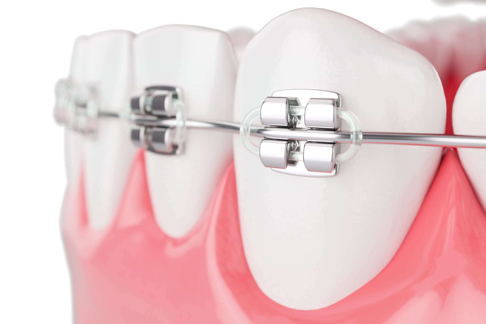 Metal Braces