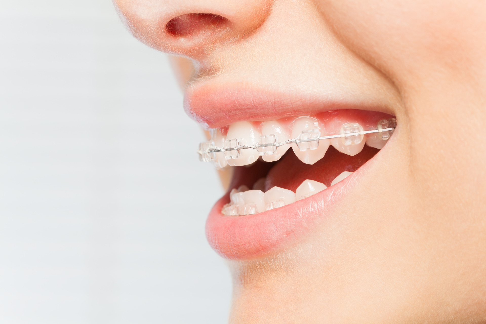 Patient with ceramic braces smiling