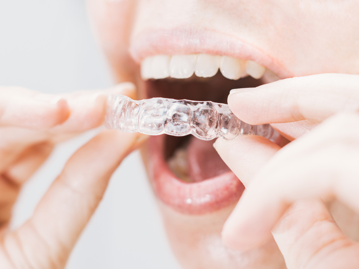 Patient wearing Angel Aligners