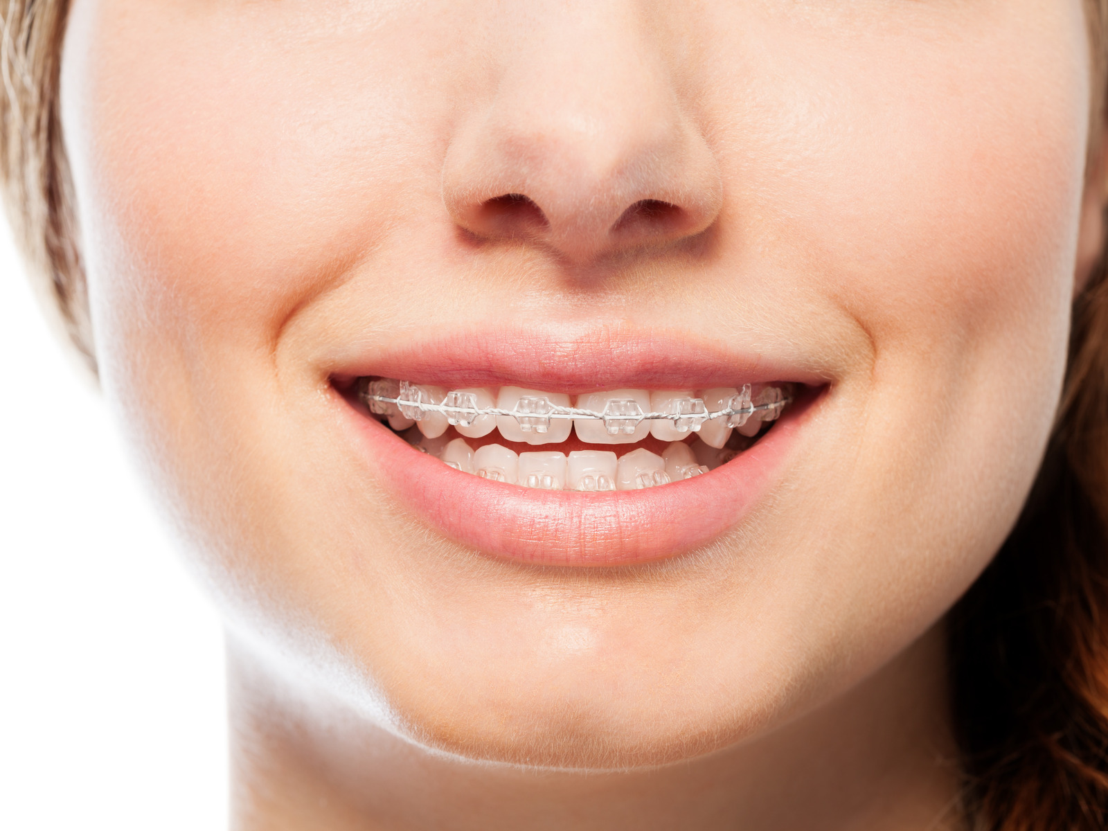 Clear Braces