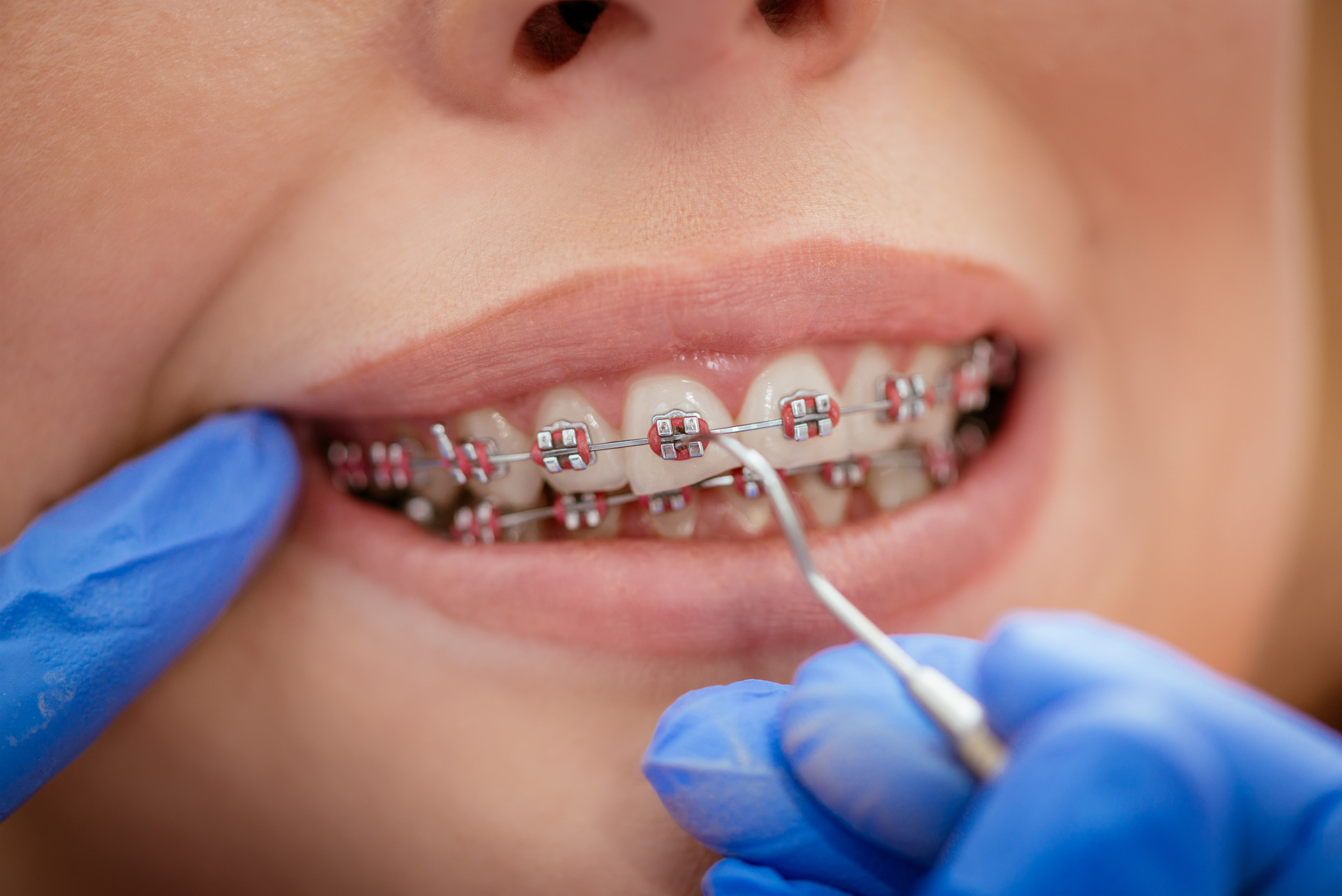 Adult orthodontic treatment