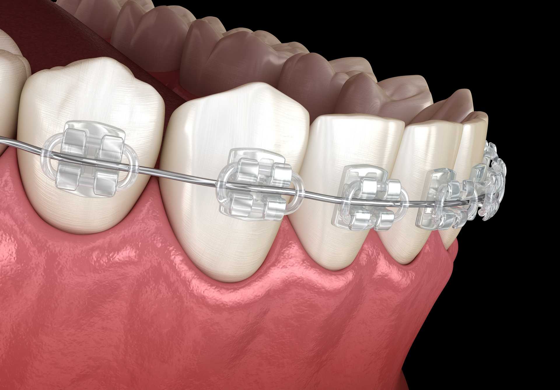 3D illustration of clear braces on teeth and gums