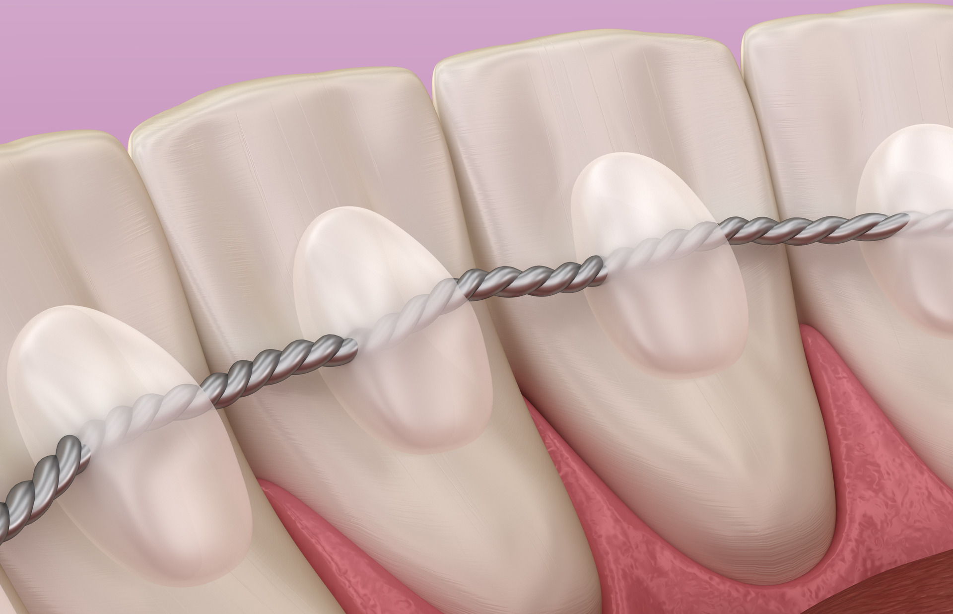 Fixed retainer wire placement.