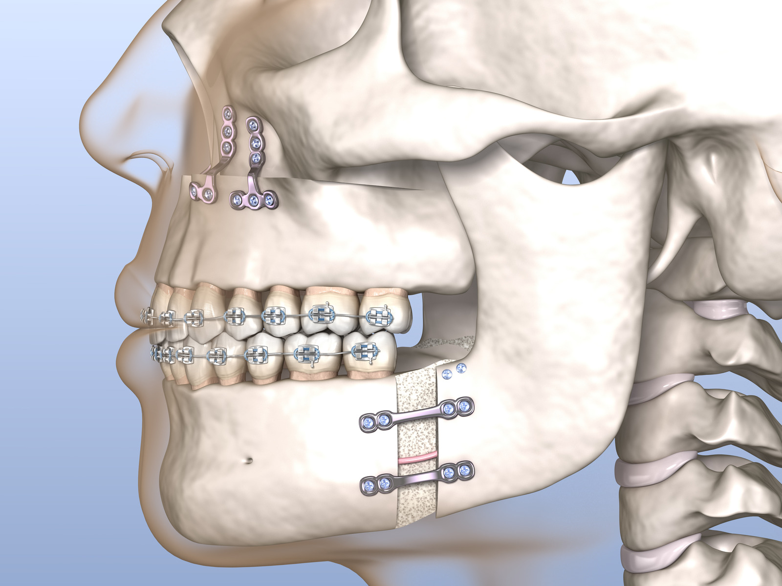 Surgical Orthodontics