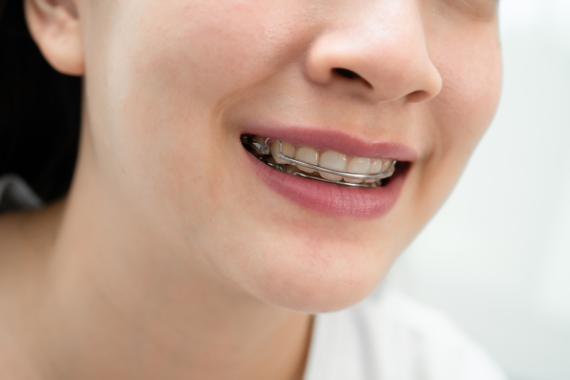 Patient wearing a Hawley retainer.