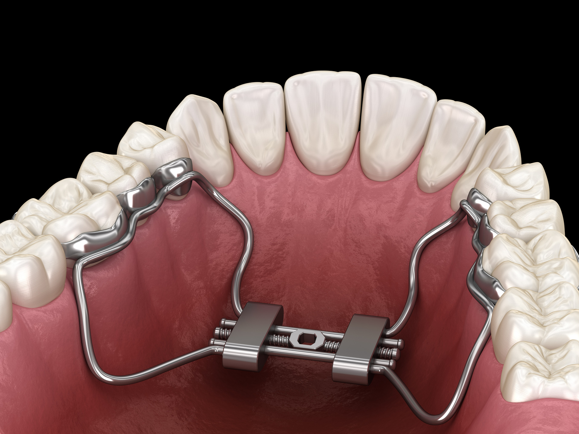 Metal braces close-up 3