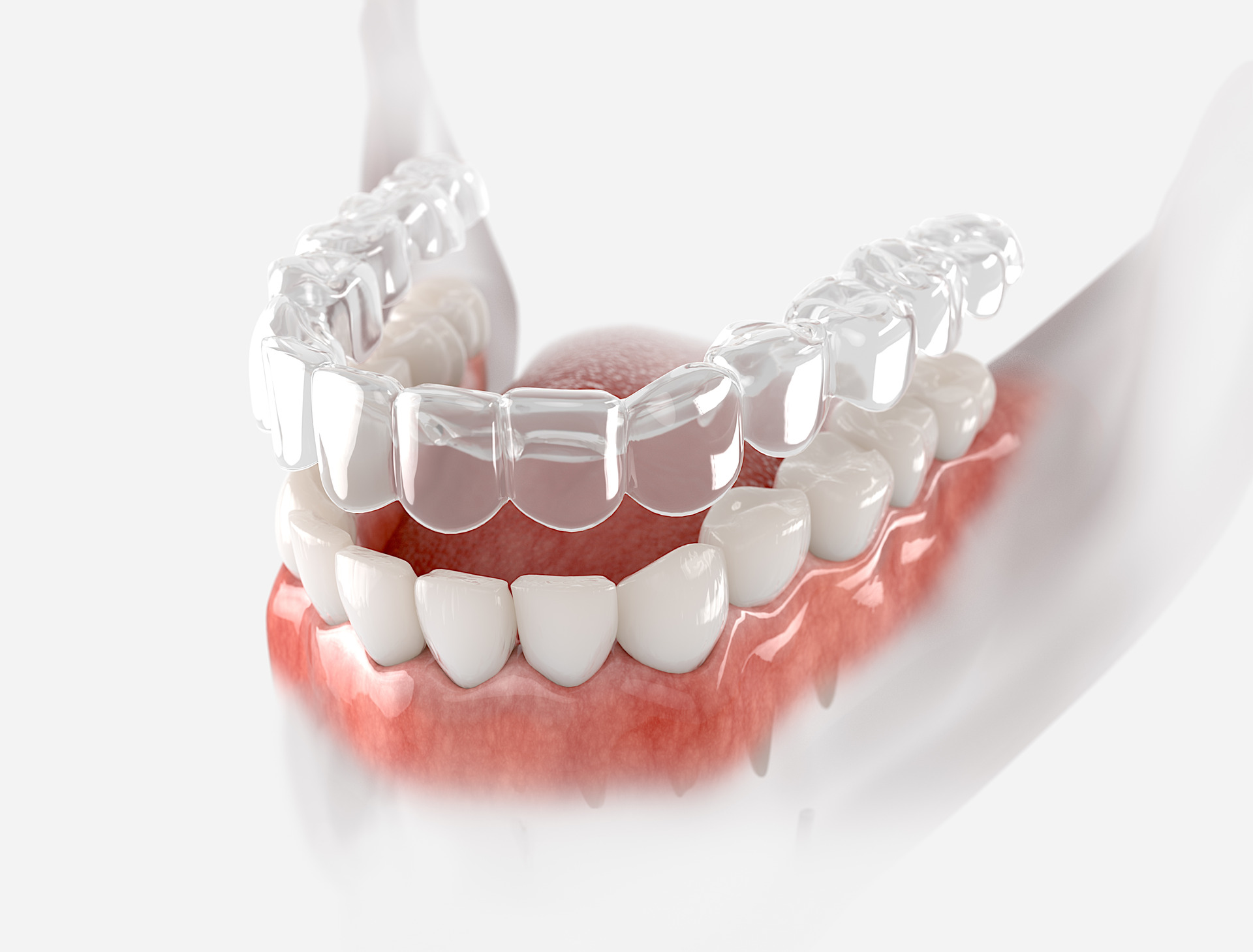 3D illustration of a transparent aligner for teeth alignment
