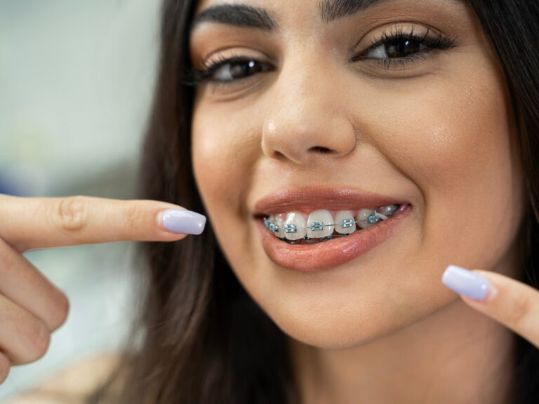 What Is The Average Cost Of Braces?