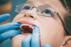 Little boy receiving braces at the orthodontist