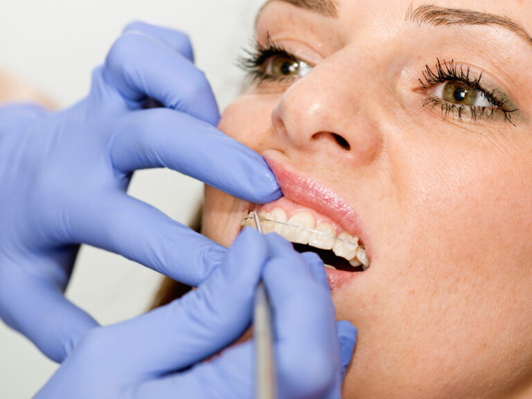 Braces Near Los Gatos, CA