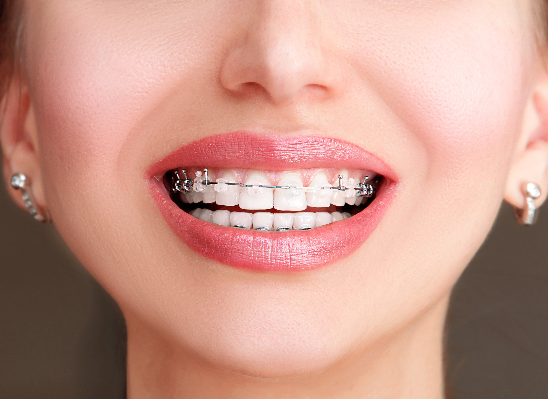 Clear self-ligating braces