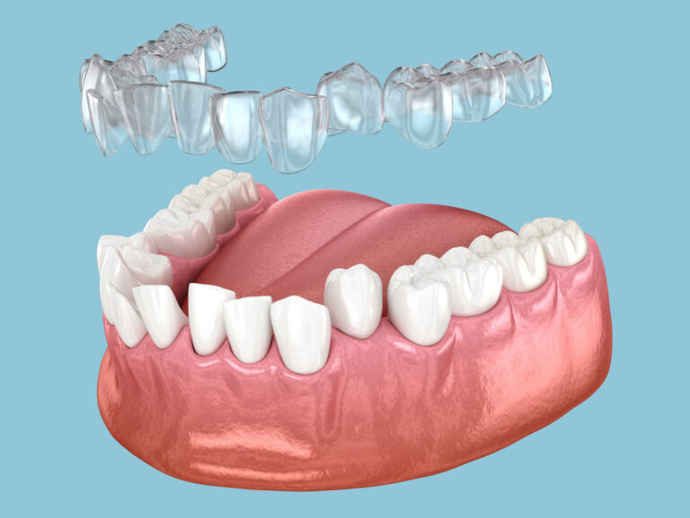 Invisalign Cost Saratoga, CA
