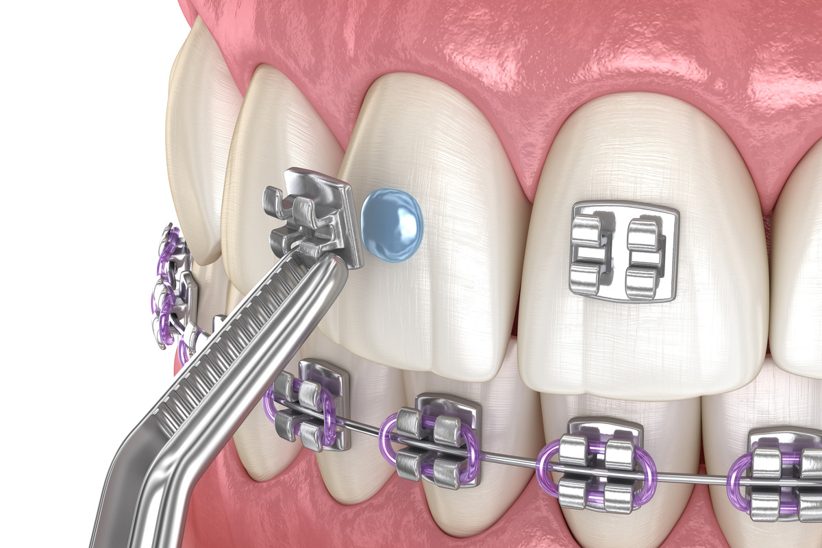3D illustration of metal braces installation process