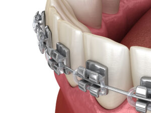 Macro view of teeth with metal braces