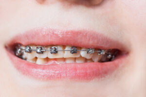 Front view of self-ligating braces on upper teeth