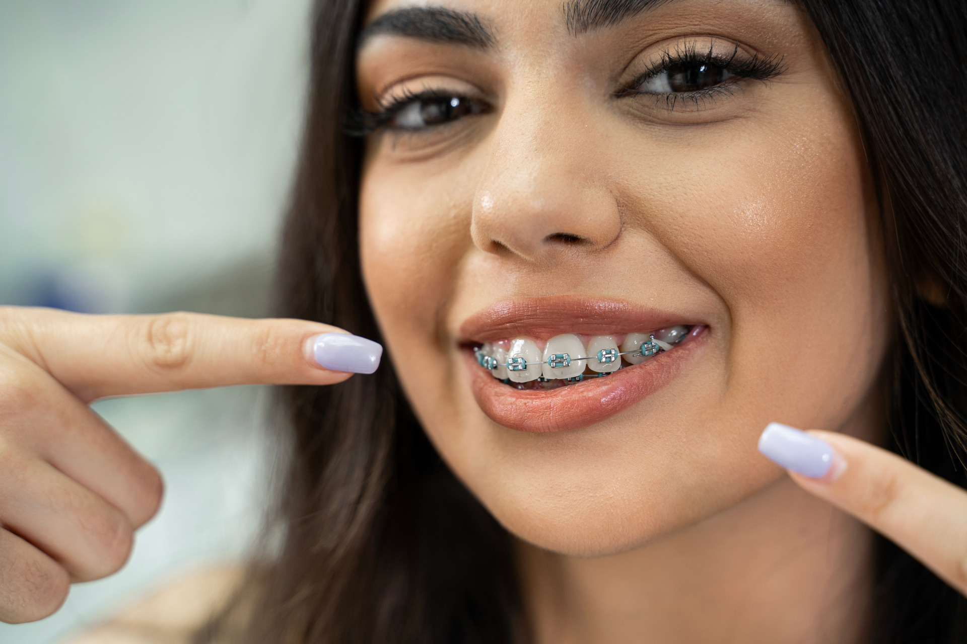 Self-ligating braces