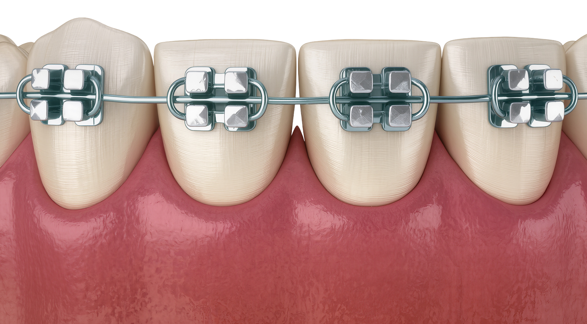 Self-ligating braces with metal brackets