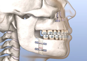 3D illustration of maxillomandibular advancement surgery
